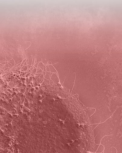 Fallo de implantación