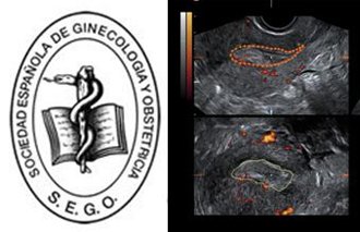 Nationale prijs in de categorie echografie van de SEGO voor de beste opdracht “echografie in gynaecologie