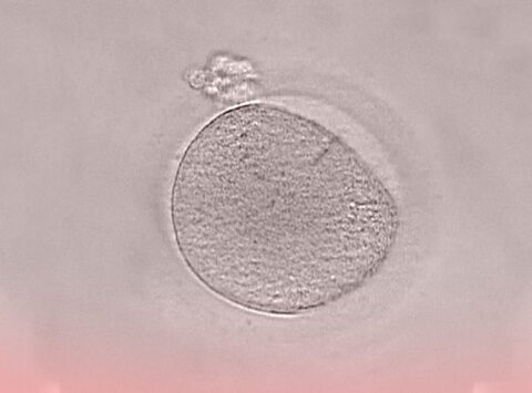 La Vitrificazione di ovuli. Preservare la fertilità al momento giusto.