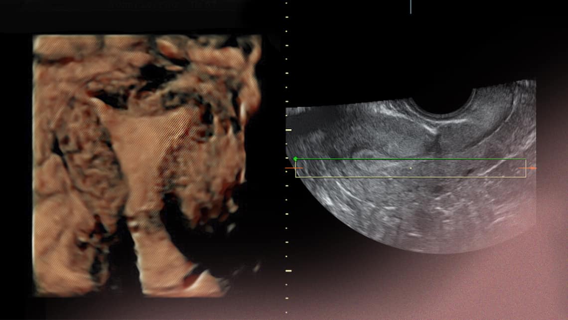 L´importanza dello spessore endometriale nei trattamenti TRA?