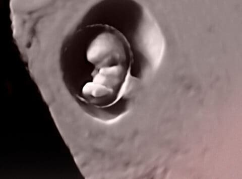 Mancato impianto embrionale e aborti ricorrenti. Trattamento e soluzioni