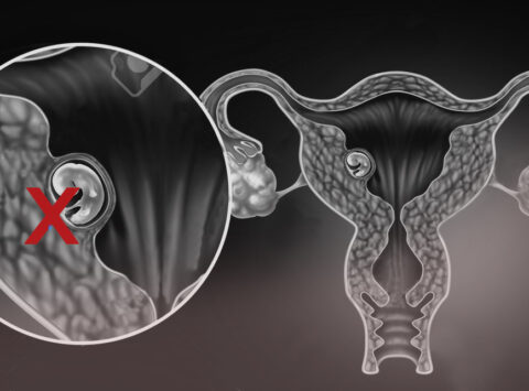 ¿Qué es un Embarazo Bioquímico?