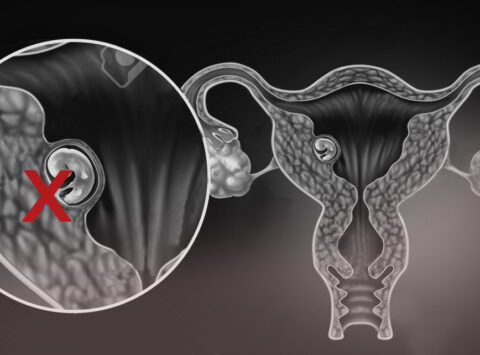 Cos`è una Gravidanza Biochimica?