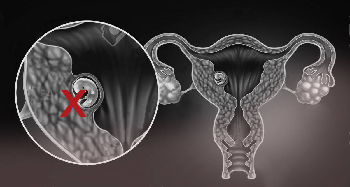 ¿Qué es un Embarazo Bioquímico?