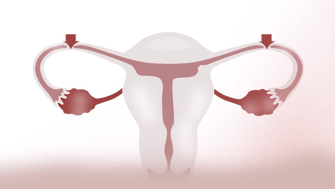 Is it possible to become a mother after tubal ligation?