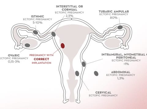 Ectopic pregnancy