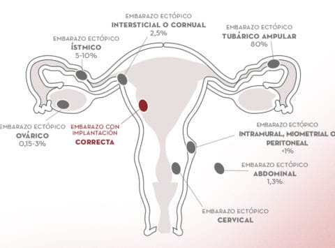 El Embarazo Ectópico