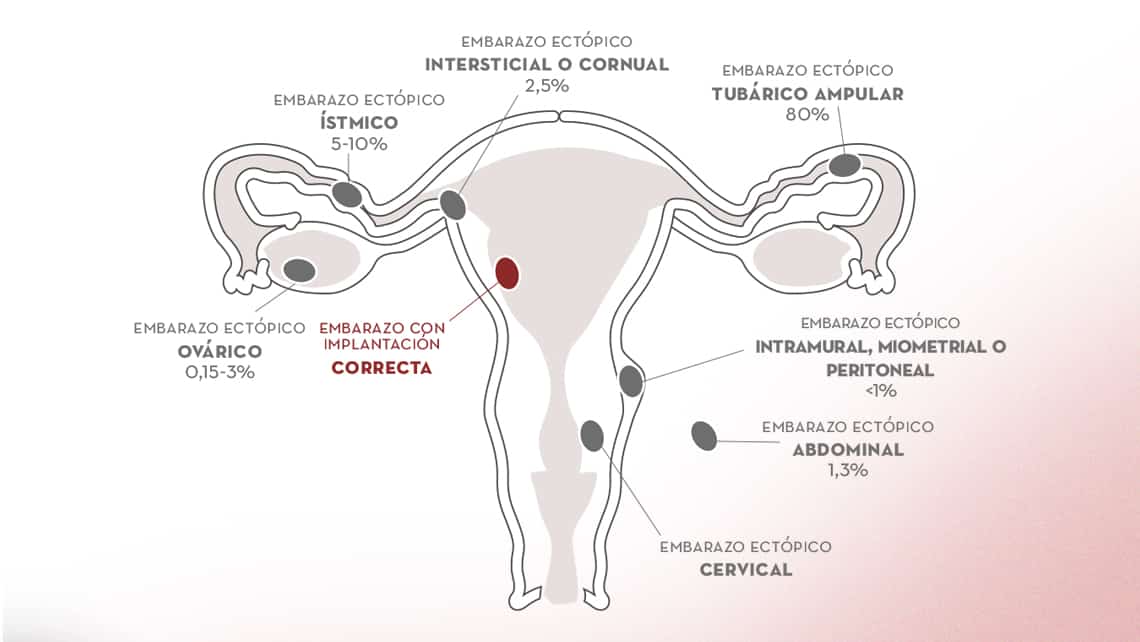 El Embarazo Ectópico