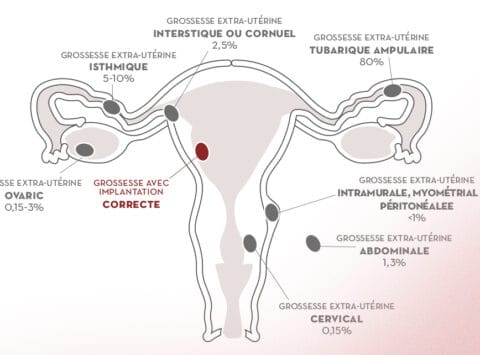 Grossesse Extra-uterine