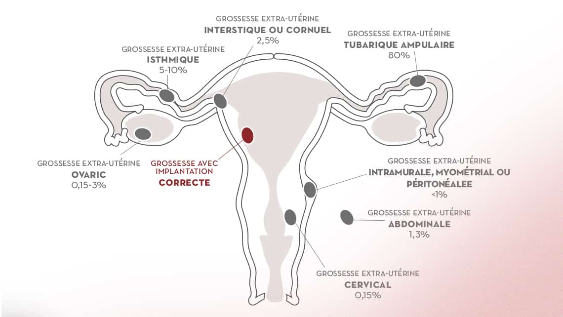 Grossesse Extra-uterine