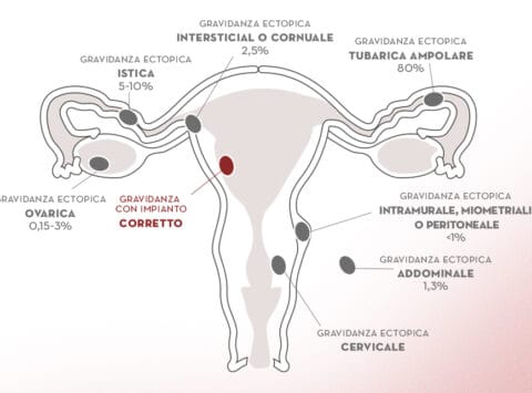 Gravidanza Extrauterina