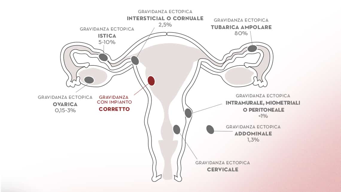 Gravidanza Extrauterina