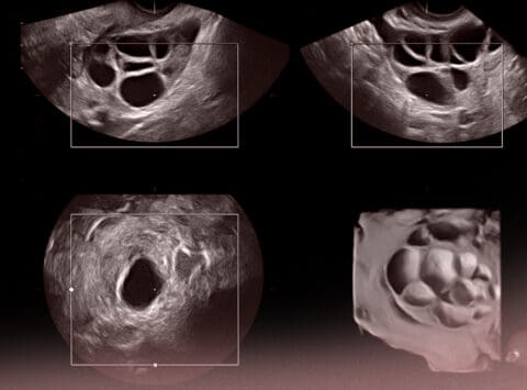 Is ovary size important?