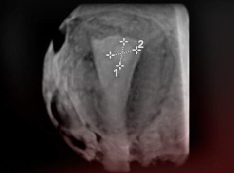 Pólipos endometriales; qué son, cómo se forman, síntomas y tratamientos