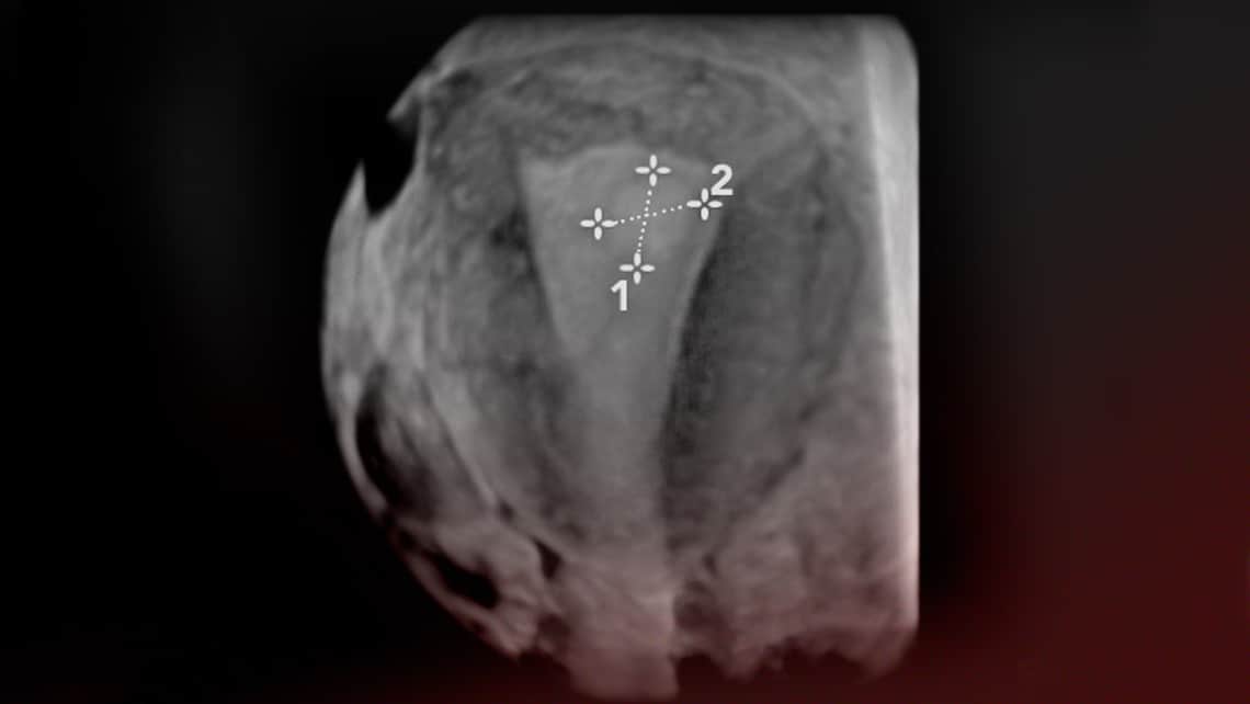 Pólipos endometriales; qué son, cómo se forman, síntomas y tratamientos