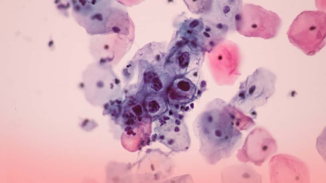 Vacunación del VPH (virus del papiloma humano) y cáncer de útero