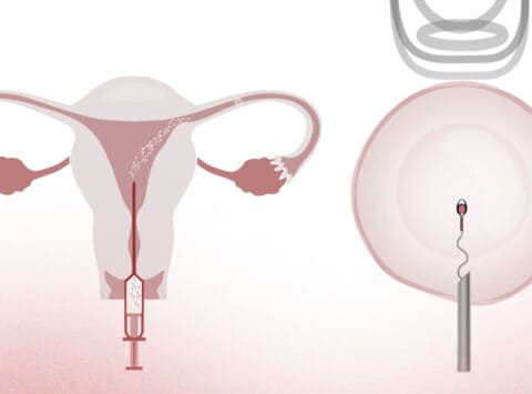 Unterschiede zwischen der Insemination und Fertilisation in Vitro (IVF)