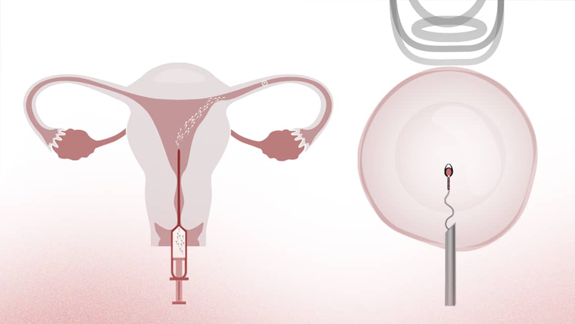 Unterschiede zwischen der Insemination und Fertilisation in Vitro (IVF)