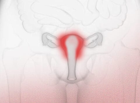 What is chronic endometritis? What is its effect in fertility?