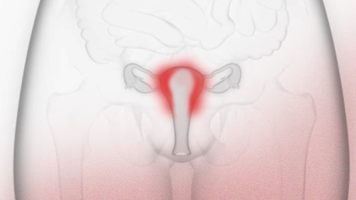 Was ist chronische Endometritis und wie wirkt sie sich auf die Fruchtbarkeit aus?