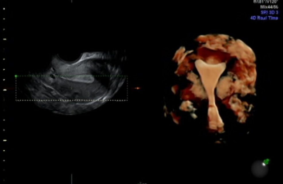 Instituto Bernabeu study relates progesterone to uterine contractility and its effect on patients with embryo implantation failure