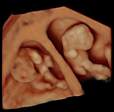Más de la mitad de las transferencias de óvulos donados son de un único embrión para evitar los embarazos múltiples en el Instituto Bernabeu