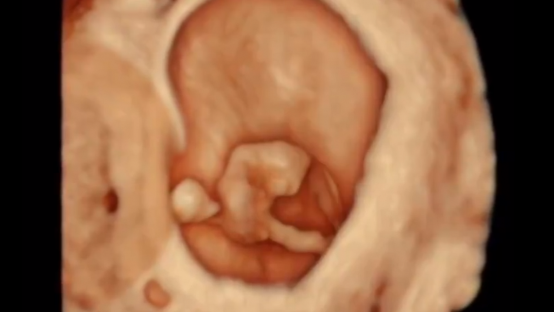 La Dr.ssa Moliner conduce un webinar per ginecologi SEF per mostrare come eseguire ecografie uterini 3D da casa