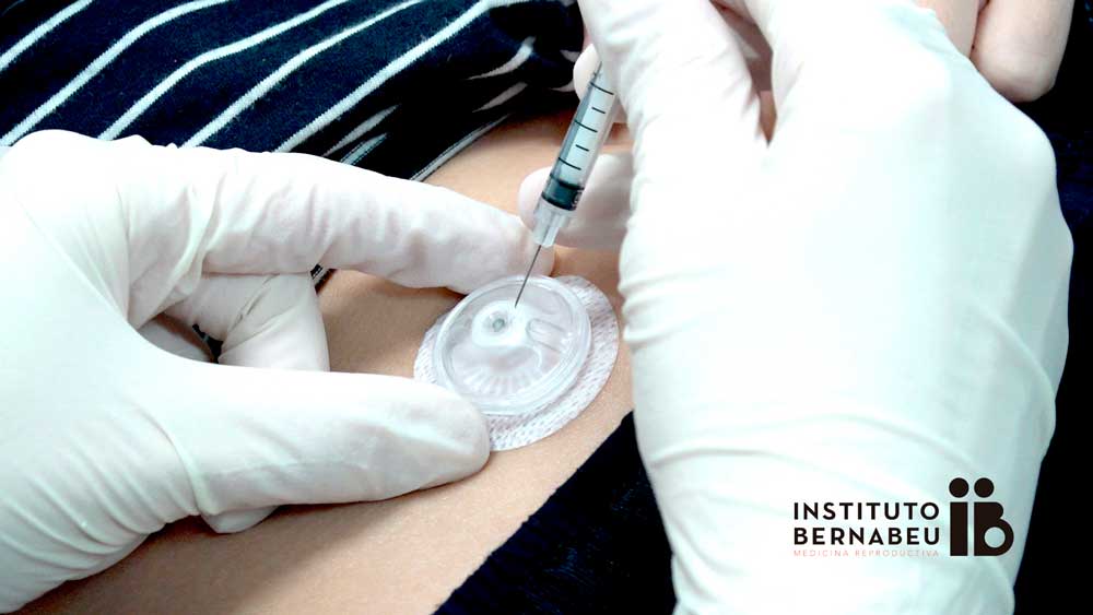 El Instituto Bernabeu revoluciona la manera de administrar los fármacos con un dispositivo que evita los pinchazos de la FIV