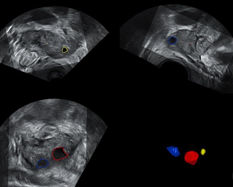 Progresso diagnostico della bassa riserva ovarica legata ai livelli di Interleuchina-10