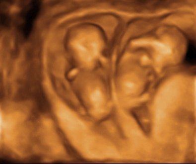 Die Häufigkeit von Zwillingsschwangerschaften steigt nach der Embryonenbiopsie, laut einer Studie des Instituto Bernabeu, die in der Fachzeitschrift JBRA veröffentlicht wurde