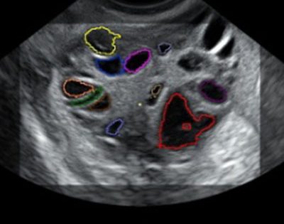 L’agopuntura può contribuire al successo di un ciclo di FIVET?