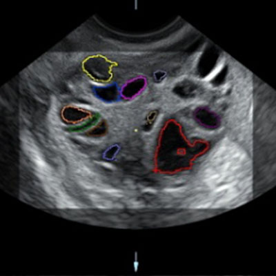 polycystic ovary syndrome