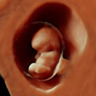 3D AND 4D ULTRASOUND SCANS