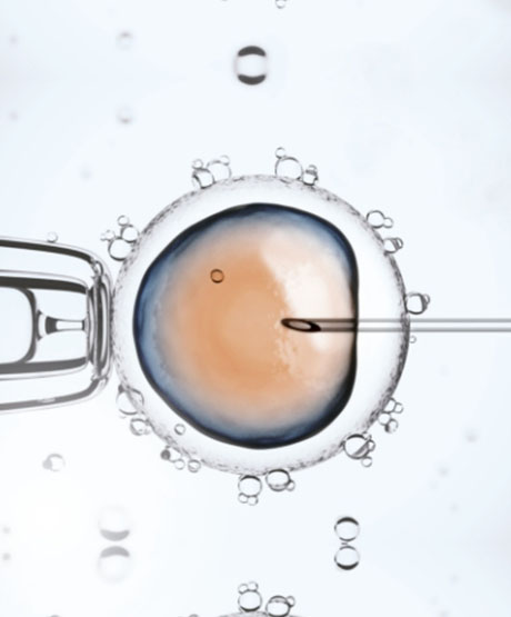 ICSI: Microinyección de espermatozoides