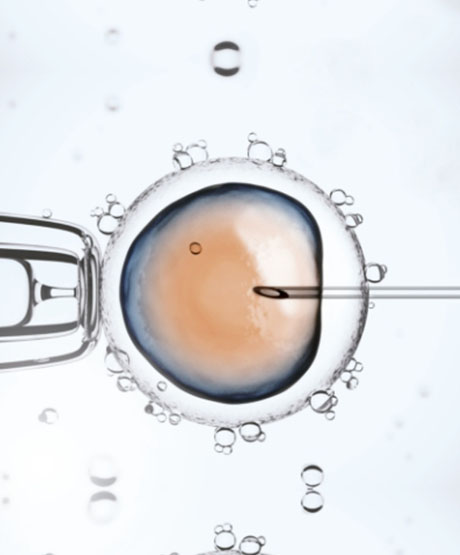 Intrazytoplasmatische Spermieninjektion (ICSI)