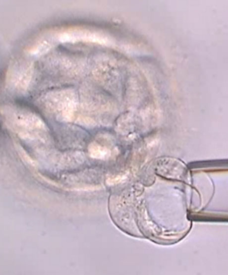 DGP / PGT: Test genético preimplantacional