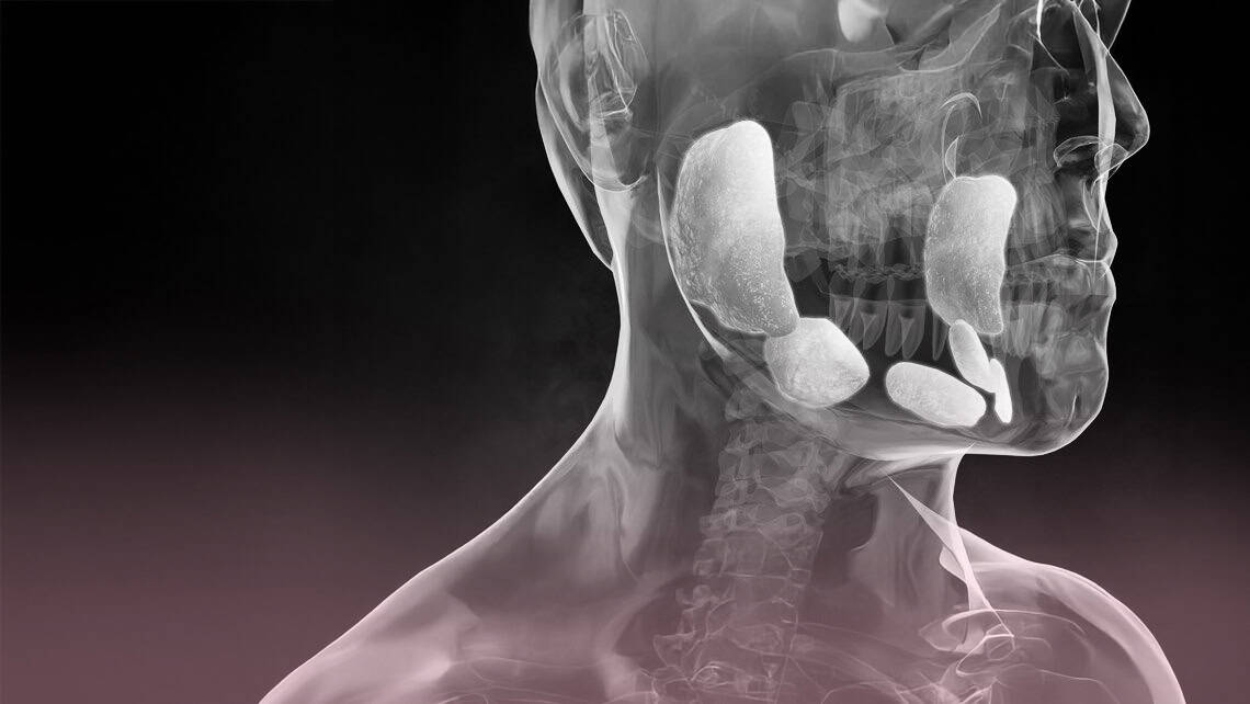 Mumps und männliche Unfruchtbarkeit