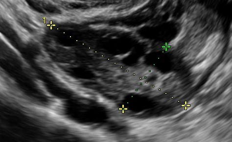 Cos'è la Riserva Ovarica? Quanto è importante per la fertilità? - Instituto Bernabeu