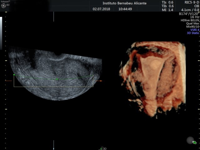 Sintomi e / o complicanze dei polipi endometriali o uterini Instituto Bernabeu