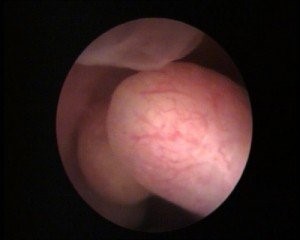 Endometrial or uterine polyp diagnosis Instituto Bernabeu