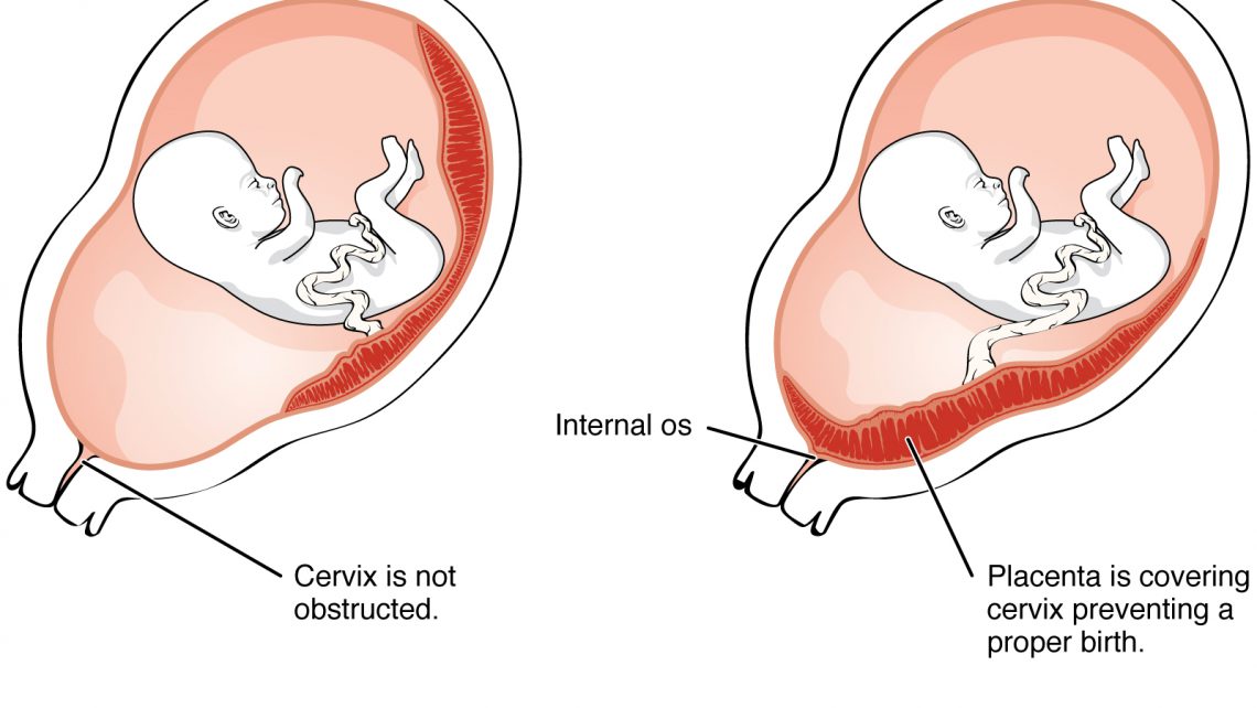 ¿Qué es la placenta previa?