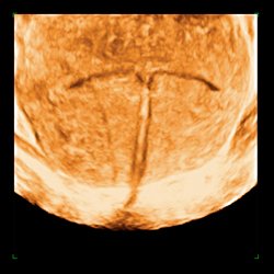 Uso de la píldora anticonceptiva ¿puede comprometer mi fertilidad?