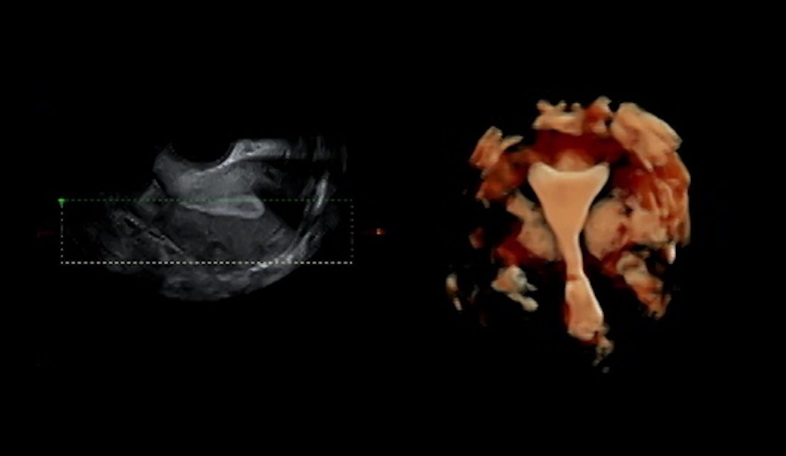 Kontraktionen der Gebärmutter: eine Herausforderung für die Implantation des Embryos