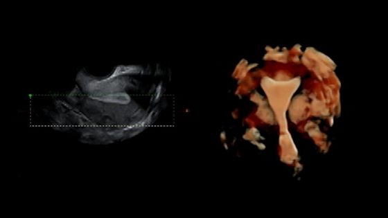 Kontraktionen der Gebärmutter: eine Herausforderung für die Implantation des Embryos