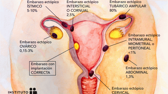 El Embarazo Ectópico
