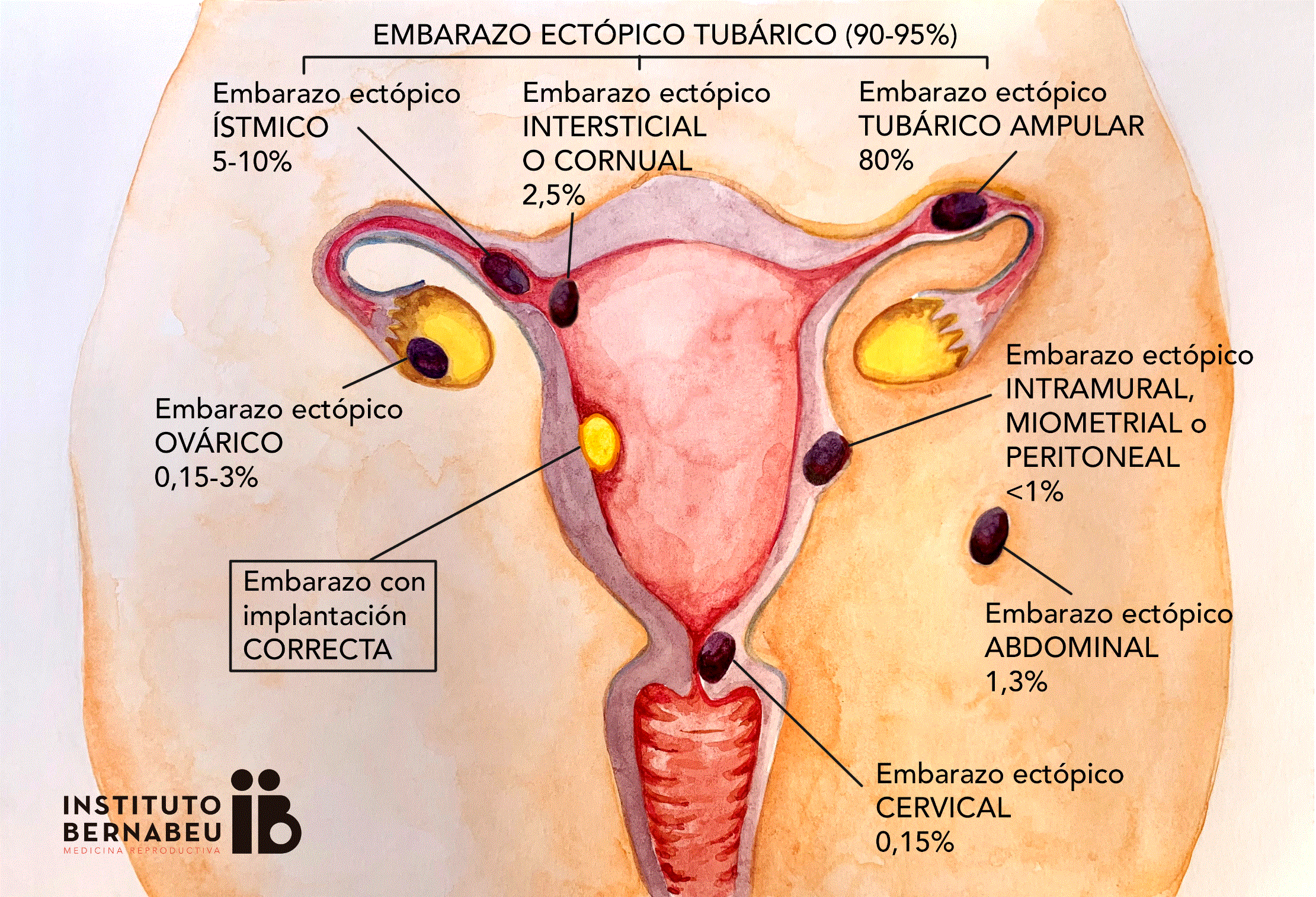 Despues de un embarazo ectopico se puede embarazar