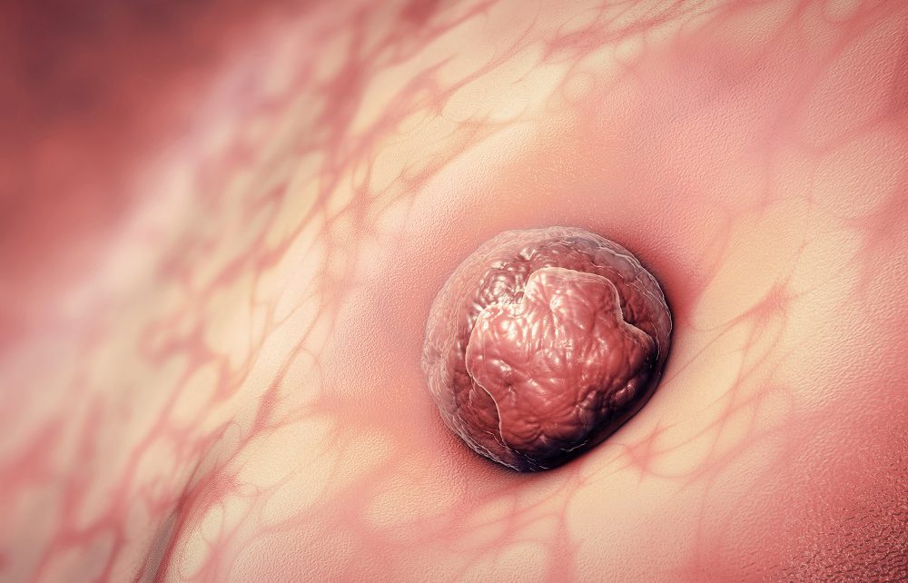 Blutung durch Embryonenimplantation