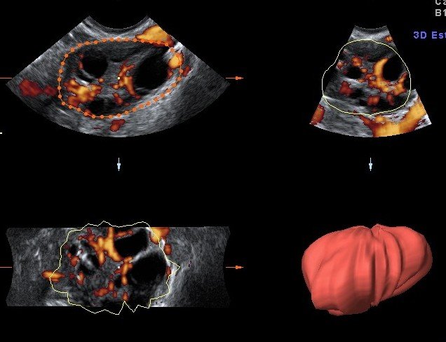 Ecografía 4D - Ginequalitas Reproducción