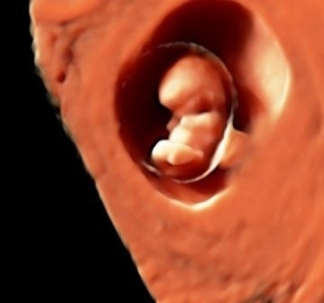 Recurrent pregnancy loss. Embryo implantation failure.