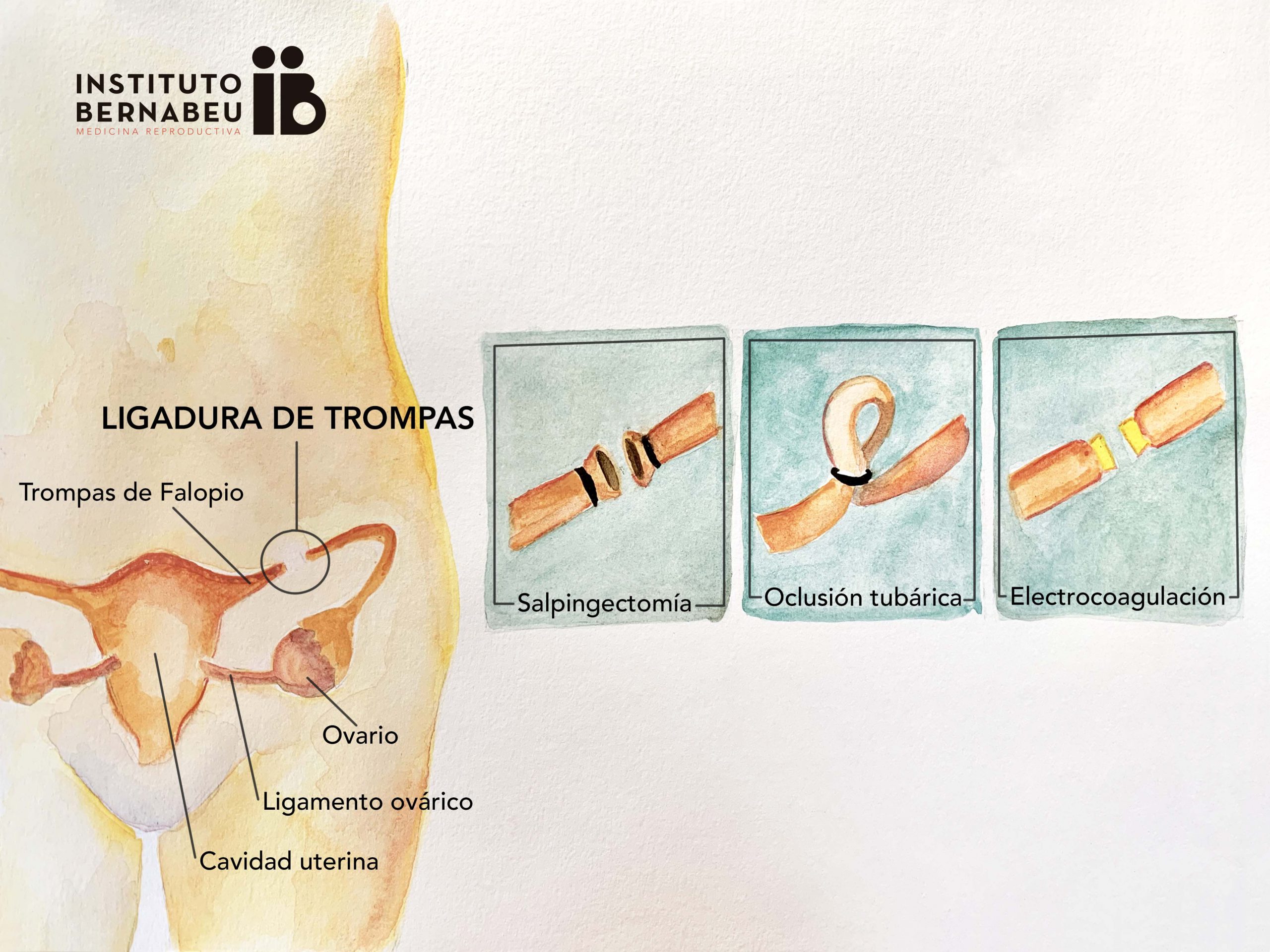 ¿En qué consiste la ligadura de trompas? Ventajas e inconvenientes de este método anticonceptivo - Instituto Bernabeu